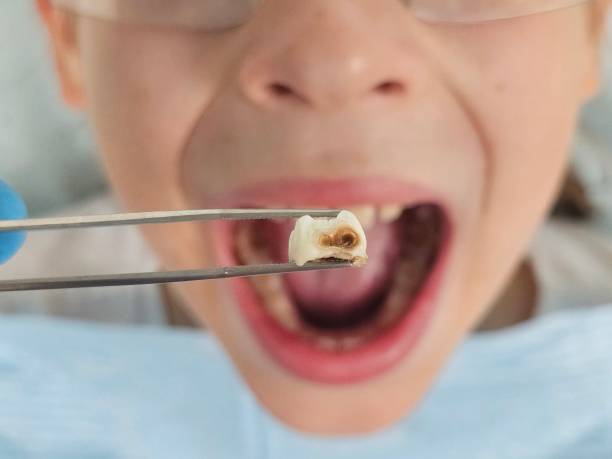 Best Emergency Broken Tooth Repair in Pemberwick, CT